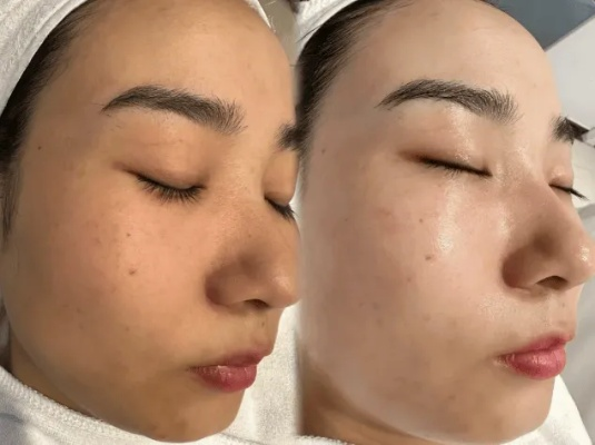 告别油光满面！盘点几款超好用的免洗祛痘面膜品牌
