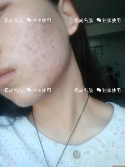 揭秘祛痘印面膜品牌代理，如何选择、合作与成功案例分享